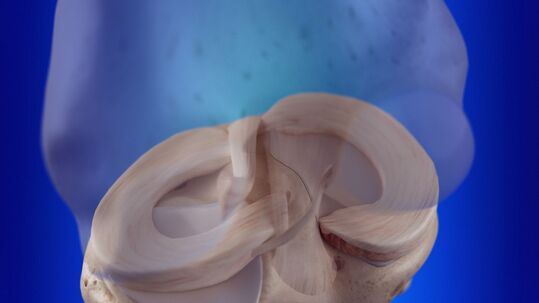 Jak vzniká zranění menisku